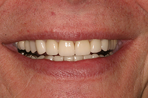 Dental Crowns After Photo